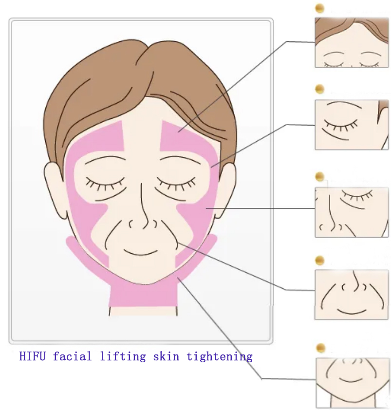 皮膚の損傷を避けるために、HIFUフェイシャルリフティング治療の前に治療ラインを描く方法は？